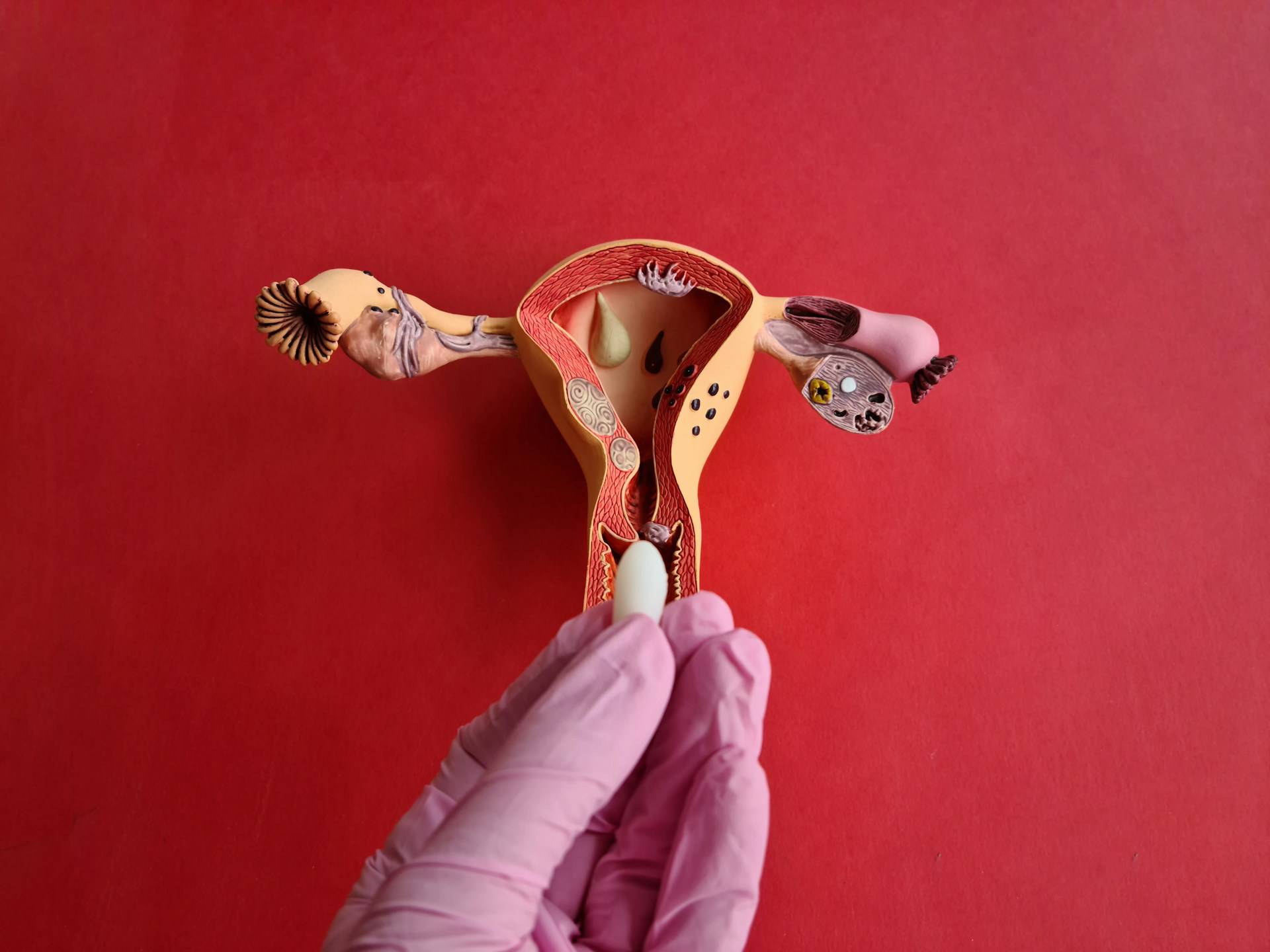 PCOS